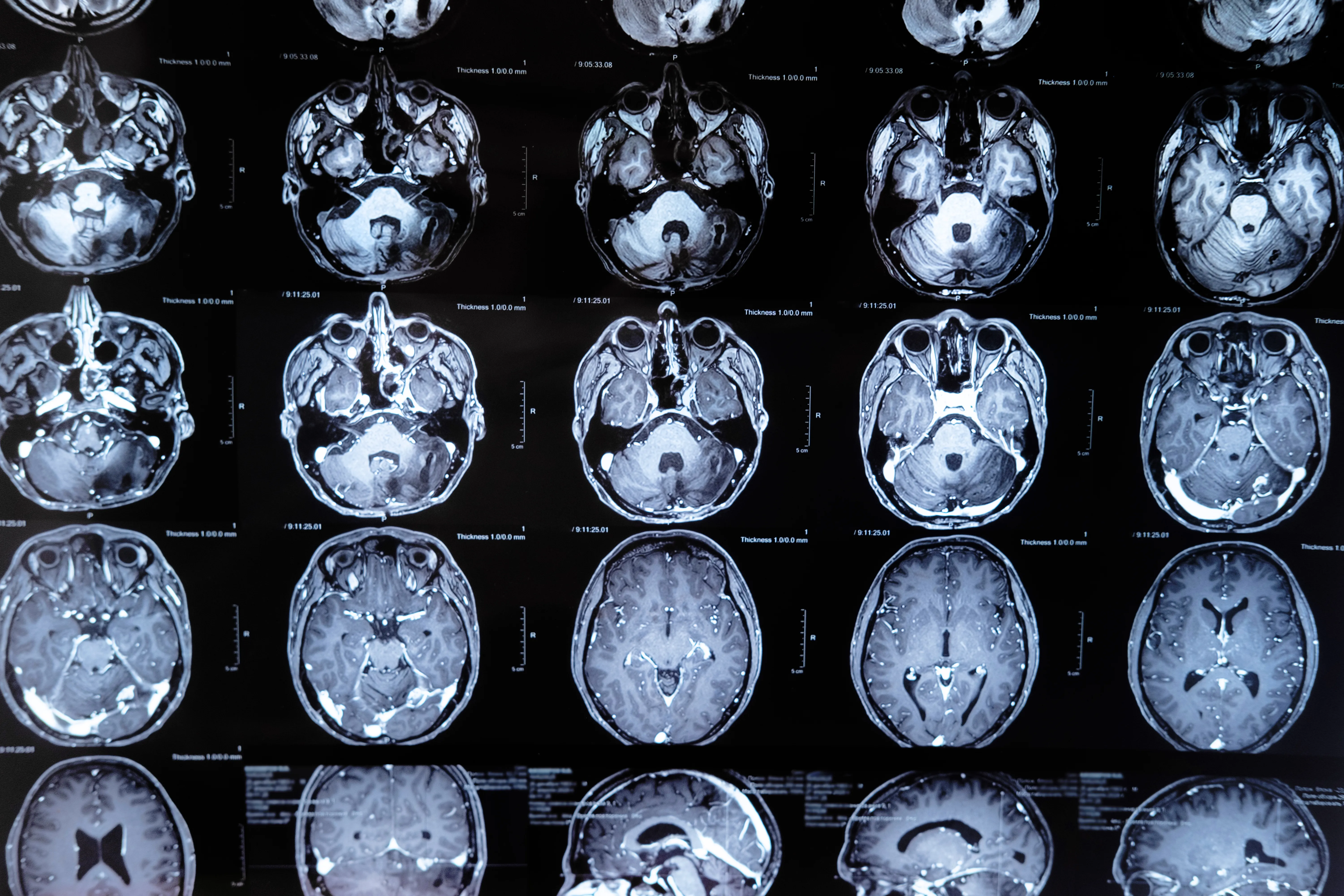 escaner cerebral