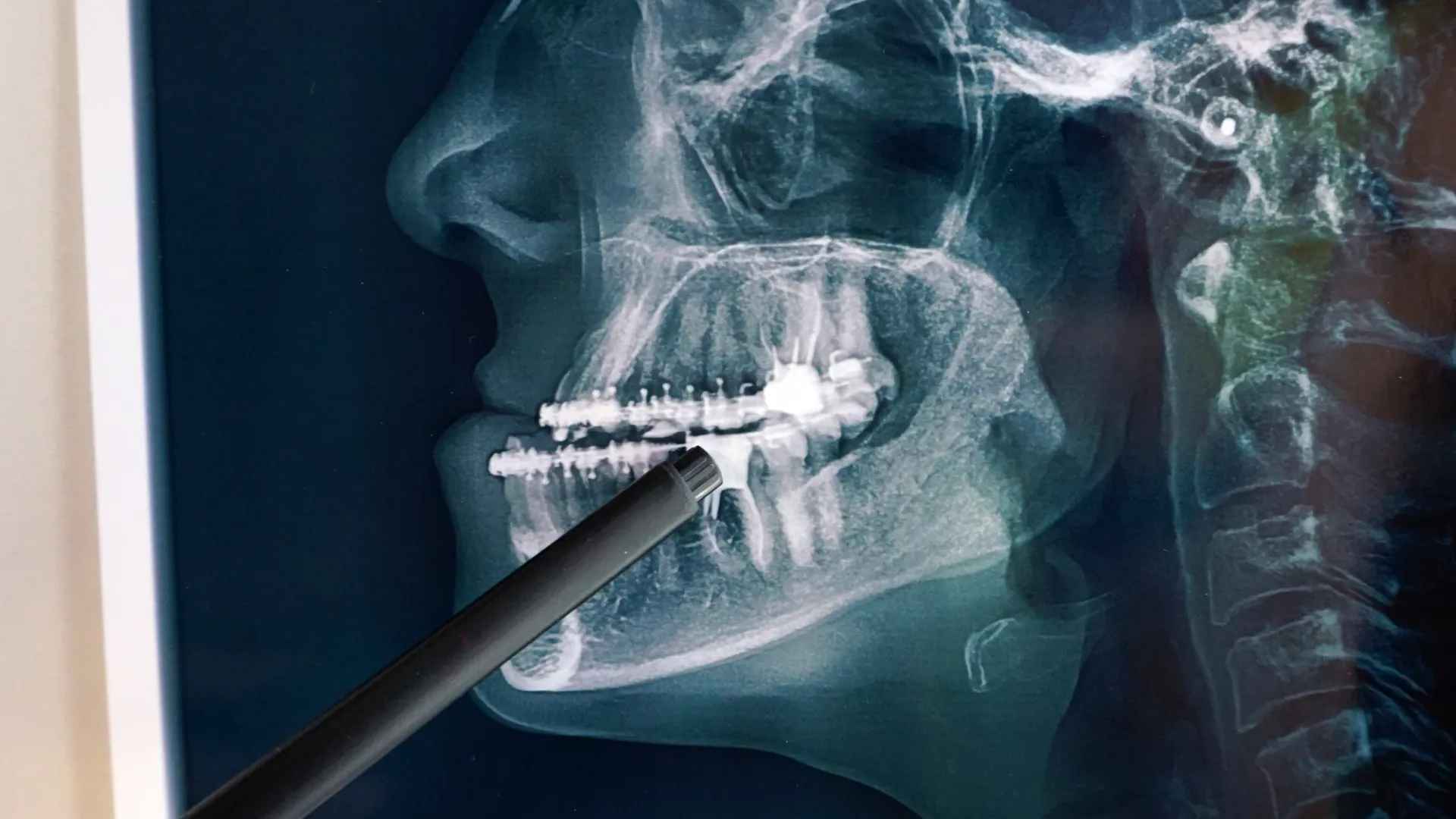 radiografía dental