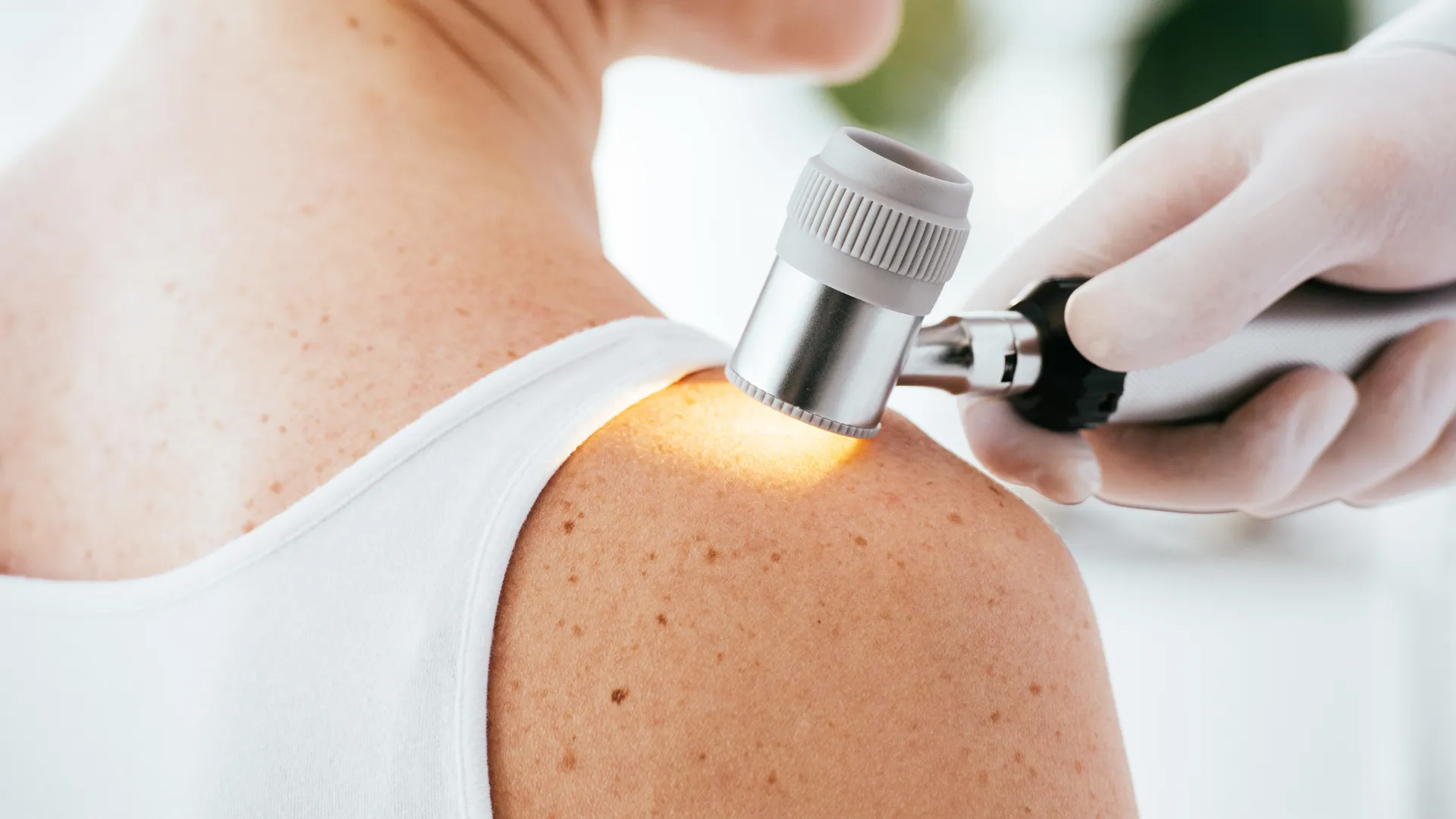 exploración de la piel del hombro en consulta dermatológica