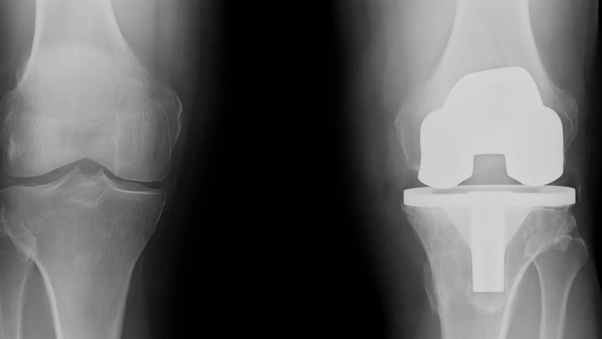 radiografía de rodilla con prótesis