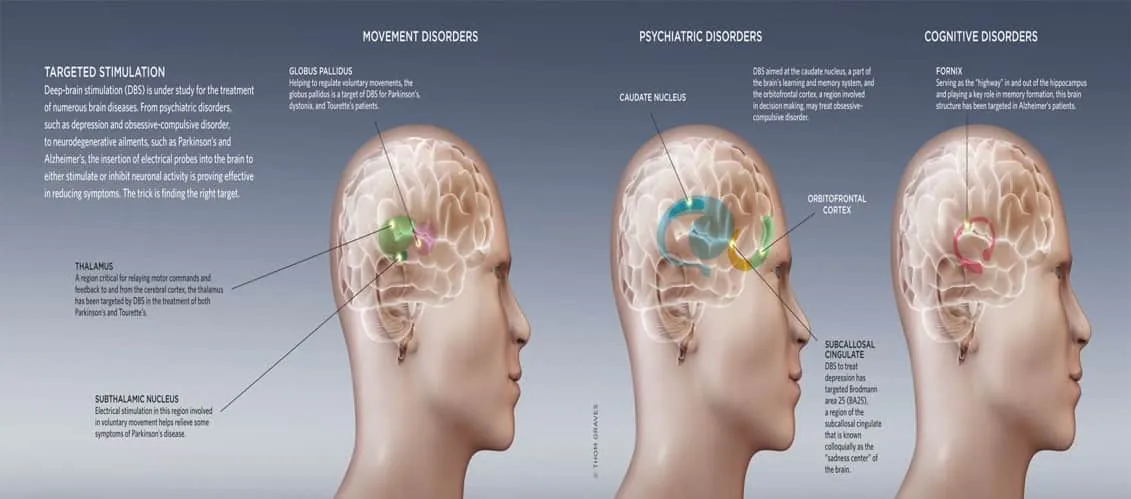 Estudio de estimulación cerebral FIDMAG