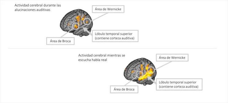 alucinaciones auditivas en pacientes con esquizofrenia